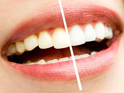 Explora nuestra selección de productos recomendados para un blanqueamiento dental eficaz y sin complicaciones. ¡Obtén tu sonrisa más blanca en casa!